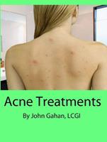   Acne Treatments