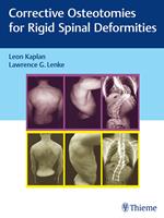   Corrective Osteotomies for Rigid Spinal Deformities