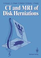   CT and MRI of Disk Herniations
