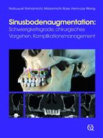   Sinusbodenaugmentation