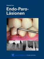   Endo-Paro-Läsionen