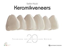  Keramikveneers