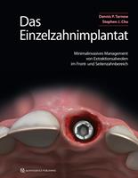   Das Einzelzahnimplantat