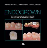 Endocrown. Una nuova via per la ricostruzione dei denti trattati endodonticamente