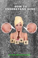   Understanding acne