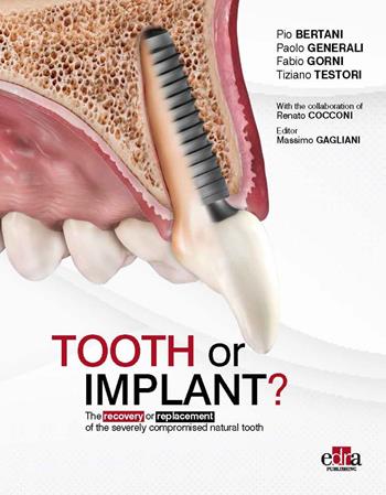 Tooth or Implant? The recovery or replacement of the severely compormised natural tooth - Pio Bertani, Paolo Generali, Fabio Gorni - Libro Edra 2024 | Libraccio.it