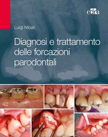 Diagnosi e trattamento delle forcazioni parodontali - Luigi Nibali - Libro Edra 2019 | Libraccio.it