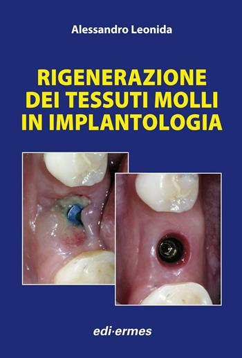 Rigenerazione dei tessuti molli in implantologia - Alessandro Leonida - Libro Edi. Ermes 2013 | Libraccio.it