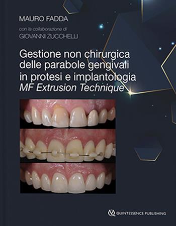 Gestione non chirurgica delle parabole gengivali in protesi e implantologia. MF extrusion technique - Mauro Fadda, Giovanni Zucchelli - Libro Quintessenza 2021 | Libraccio.it