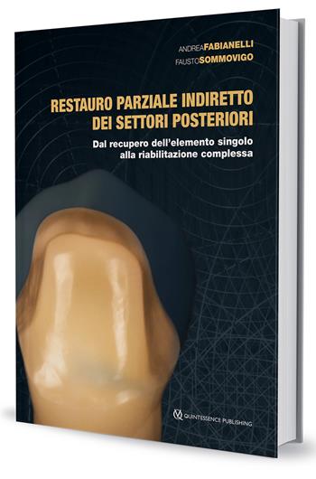 Restauro parziale indiretto dei settori posteriori. Dal recupero dell'elemento singolo alla riabilitazione complessa - Andrea Fabianelli, Fausto Sommovigo - Libro Quintessenza 2022 | Libraccio.it