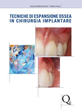 Tecniche di espansione ossea in chirurgia implantare - Giovanni Battista Bruschi, Roberto Crespi - Libro Quintessenza 2011 | Libraccio.it