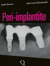 Peri-implantite