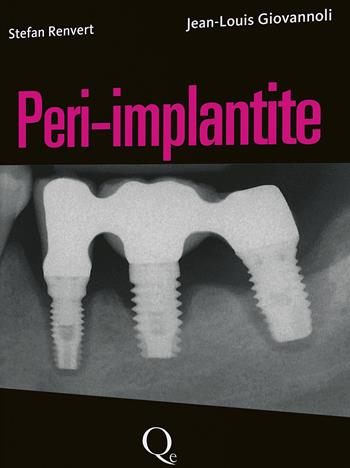 Peri-implantite - Stefan Renvert, Jean-Louis Giovannoli - Libro Quintessenza 2014 | Libraccio.it
