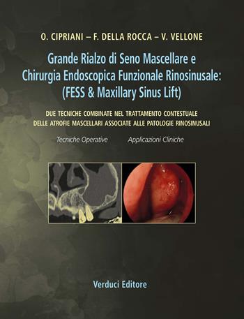 Grande rialzo di seno mascellare e chirurgia endoscopica funzionale rinosinusale. Due tecniche combinate nel trattamento contestuale delle atrofie mascellari associate alle patologie rinosinusali  - Libro Verduci 2019 | Libraccio.it