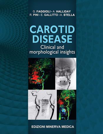 Carotid disease. Clinical and morphological insights - Gianluca Faggioli, Alison Halliday, Rodolfo Pini - Libro Minerva Medica 2017 | Libraccio.it