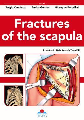 Fractures of the scapula. Ediz. illustrata - Sergio Candiotto, Enrico Gervasi, Giuseppe Porcellini - Libro Timeo 2021 | Libraccio.it