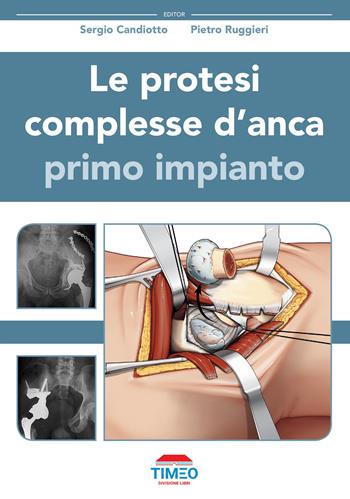 Le protesi complesse d'anca. Primo impianto - Sergio Candiotto, Pietro Ruggieri - Libro Timeo 2022 | Libraccio.it