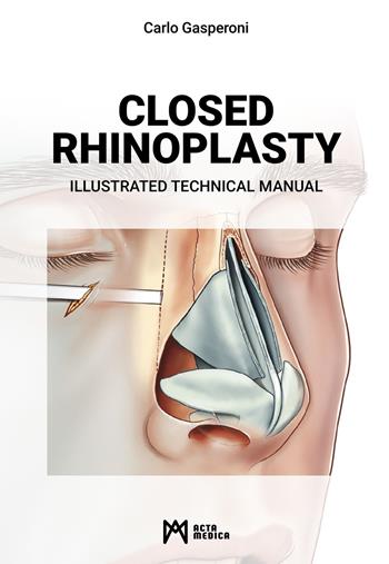 Closed rhinoplasty. Illustrated technical manual - Carlo Gasperoni - Libro Acta Medica Edizioni 2022 | Libraccio.it