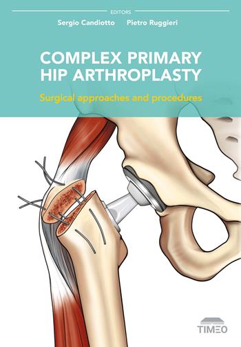 Complex primary hip arthroplasty. Surgical approaches and procedures - Sergio Candiotto, Pietro Ruggieri - Libro Timeo 2025 | Libraccio.it